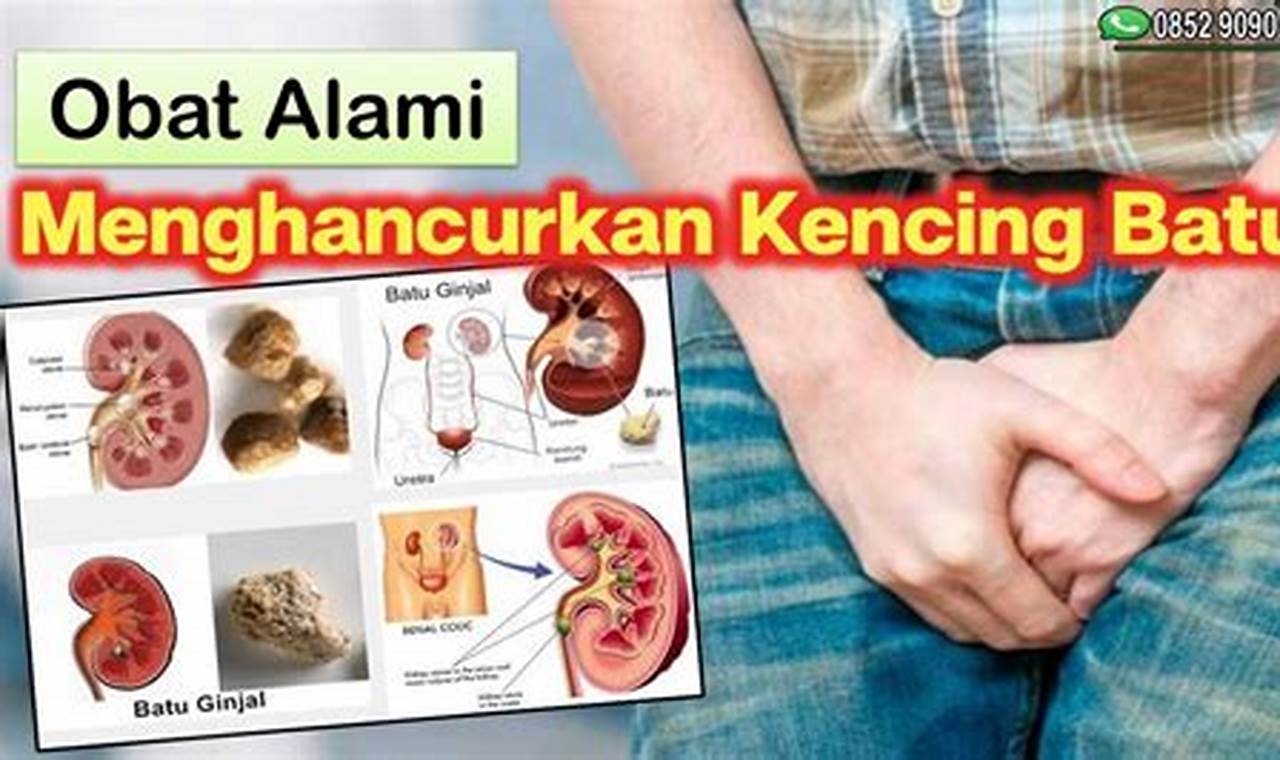 Cara Mengatasi Kencing Batu